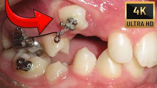 🔥Unexpected orthodontic impaction🔥Timelapse of BRACES in 4K [upl. by Cahan595]