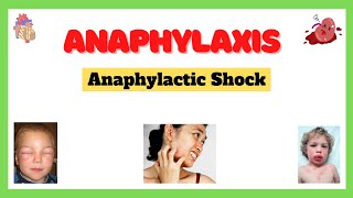 Anaphylactic Shock Anaphylaxis Signs and Symptoms Causes Complications Treatment Made Easy [upl. by Aldric334]