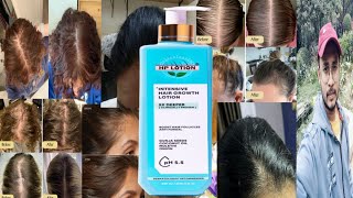 HP Lotion Intensive Hair Growth Lotion  Honest Review [upl. by Yenttirb870]