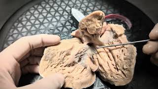 Specimen walkthrough 11 Double inlet left ventricle Cardiac anatomy cardiac pathology [upl. by Ailaza]