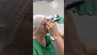 Cirurgia de ptose e blefaroplastia combinada [upl. by Alhak]