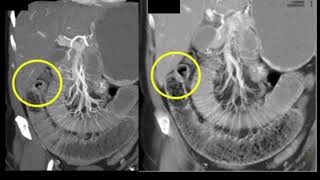 MDCT of the Small Bowel and Mesentery Inflammatory Diseases Part 1 [upl. by Festatus746]