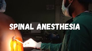 How to give spinal anesthesia  LEARN IN 1 MINUTE [upl. by Doralin]