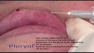 Pluryal® Lips Augmentation [upl. by Gombosi448]