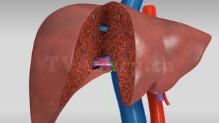 Liver transplant Living donor right hepatectomy donor procedure [upl. by Childs]