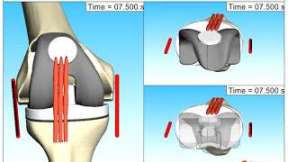 Knee joint kinematics during flexionextension have been analyzed via Multibody Simulation SIMPACK [upl. by O'Reilly]