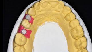 Passo a passo de prótese sobre implante cimentada em Emax [upl. by Woodie]