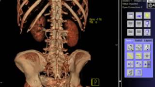 3D Vision of Urinary System  Visione 3D dellApparato Urinario [upl. by Bandler475]