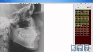 Manuseando Ferramentas da Cefalometria [upl. by Eloise]