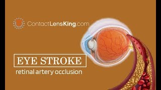 Eye Stroke Retinal Artery Occlusion Retinal Vein Occlusion What Causes It What are the Symptoms [upl. by Eneliak]