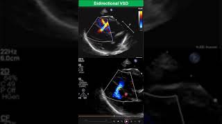 Bidirectional Ventricular Septal Defect Early Stage of Eisenmenger Syndrome [upl. by Kennedy]