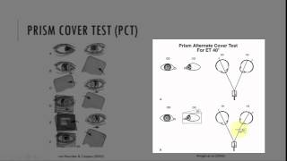 Cover uncover alternating cover test amp measuring Squint with prism bar [upl. by Namref268]