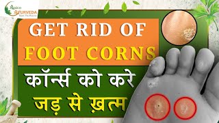 GET RID OF FOOT CORNS कॉर्न्स को करें जड़ से खत्म Axico Ayurveda [upl. by Ahsekar]