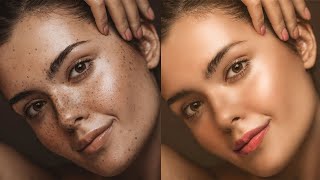 Full Guide to Freckles Treatment At Home Lasers Lightening creams DIYs for Removing Freckles [upl. by Dawn]