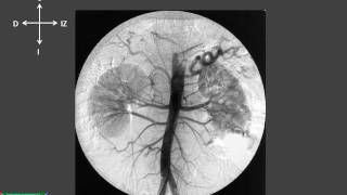 Estudio radiográfico contrastado de las arterias del abdomen [upl. by Belanger]