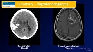 Emergency Imaging of Brain Tumors Oligodendrogliomas amp Others [upl. by Supmart465]