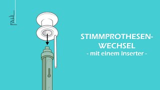 Stimmprothesenwechsel mit einem Inserter  Animation  Fahl MedizintechnikVertrieb GmbH [upl. by Alleira982]