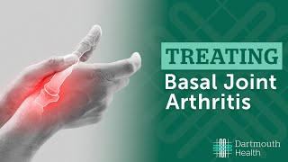 Basal Joint Arthritis [upl. by Hatfield]