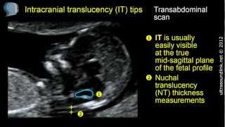 Intracranial translucency IT tips and tricks [upl. by Tena]