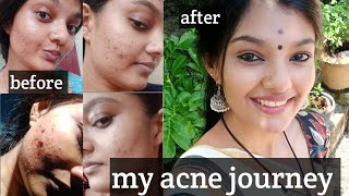 acne peel ചെയ്തപ്പോൾ എനിക്ക് സംഭവിച്ചത്acne journeymy experience acneproneskinitsmeaparna [upl. by Aleirbag]