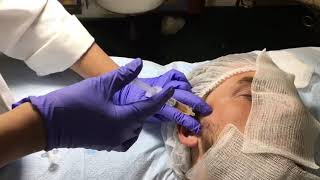 PRP Treatment for TMJ temporomandibular [upl. by Seaden]