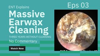 Satisfying Earwax Cleaning 3 Cholesteatoma No Commentary [upl. by Neel]