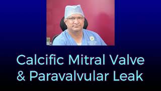 Calcific Mitral Valve and Paravalvar Leak Part 1 [upl. by Albarran]