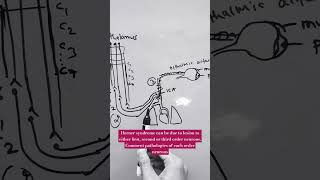 HORNER SYNDROME  lateral medullary syndrome lung apex tumor internal carotid dissection [upl. by Nolita766]