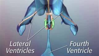 Anatomy of Hypothalamic Hamartoma [upl. by Delaryd801]