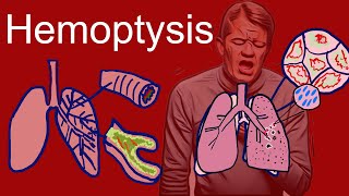 Hemoptysis Coughing Up Blood  Causes types symptoms [upl. by Avie748]