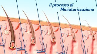 Alopecia Androgenetica il processo di Miniaturizzazione [upl. by Asteria964]