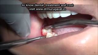 Lower wisdom tooth with gum infection extractionVIDEO [upl. by Akinajnat]