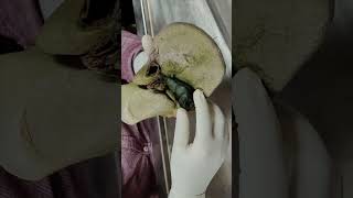 Location of gallbladder gallbladder fossa shortvideo anatomy biology gallbladderanatomy [upl. by Grata]