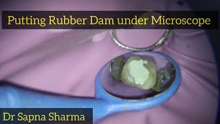 Rubber Dam Placement on Upper Molar  Rubber Dam Application under Microscope [upl. by Artinahs]