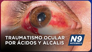 TRAUMATISMO OCULAR POR ÁCIDOS Y ÁLCALIS  NOTICIERO 9 [upl. by Refanej]