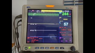 Treatment of PSVT by Inj Adenosine  demo of 2 syringe rapid flush technique [upl. by Karia]