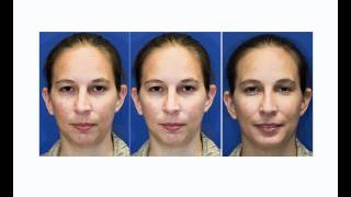 Before amp After Seattle Rhinoplasty Nose job  Crooked Nose and Chin Augmentation [upl. by Odidnac162]