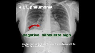 Basic semiology of chest radiology illustrated by clinical casesSilhouette Sign [upl. by Hizar742]