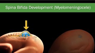 Fetal Spina Bifida Comprehensive Guide on Diagnosis Treatment amp Surgery [upl. by Silrak]