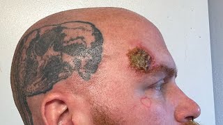 Week 4 Superficial Basal Cell Carcinoma Skin Cancer Aldara Treatment [upl. by Attehcnoc]