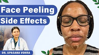 Peeling Side Effects On Skin  Chemical Peeling Ke Side Effects  Upasana Ki Duniya [upl. by Ahsekyw160]