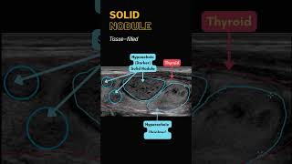 Thyroid Nodule Ultrasound  Cystic Solid Complicated Calcifications [upl. by Ahders]