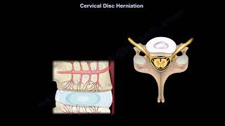 Cervical Disc Herniation What Is The Intervertebral Disc what is a disc herniation [upl. by Lesab]