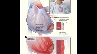 Pericarditis Definition Causes Clinical features Treatment and Prognosis [upl. by Eimarej723]