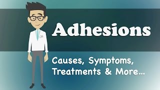 Adhesions  Causes Symptoms Treatments amp More… [upl. by Debbra]