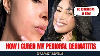 HOW I CURED MY PERIORAL DERMATITIS IN THREE 3 DAYS [upl. by Eltsyrk]