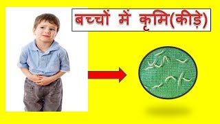 Stomach worms in kidsबच्चों में कृमिकीड़े [upl. by Nahsor387]