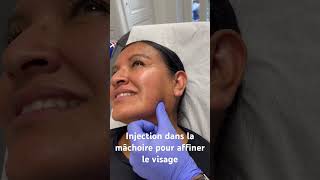 Injection de Botox dans la mâchoire pour affiner le visage DrHerveRaspaldo [upl. by Caylor476]