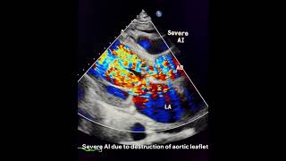 Infective Endocarditisto drahmadmirdamadisiy66XFU4h2QChqFiV [upl. by Pascal115]