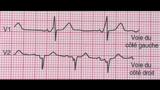 Syndrome de WolffParkinsonWhite [upl. by Eanom]